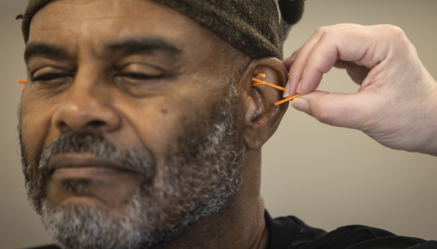 Acupuncture has been use for decades to TRAI AdDICTION – Advocates Want to Expand Its Reach